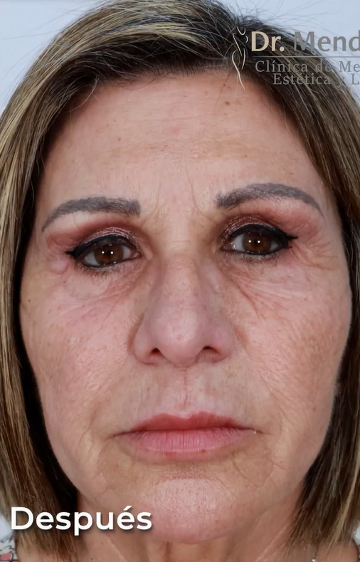 Revitaliza tu piel con mesoterapia facial Experimenta un rejuvenecimiento profundo con microinyecciones vitamínicas precisas e indoloras en la clínica del Dr. Mendieta, mejorando la textura y elasticidad de tu piel.