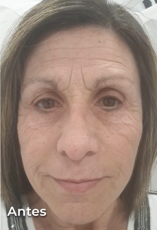 Revitaliza tu piel con mesoterapia facial Experimenta un rejuvenecimiento profundo con microinyecciones vitamínicas precisas e indoloras en la clínica del Dr. Mendieta, mejorando la textura y elasticidad de tu piel.