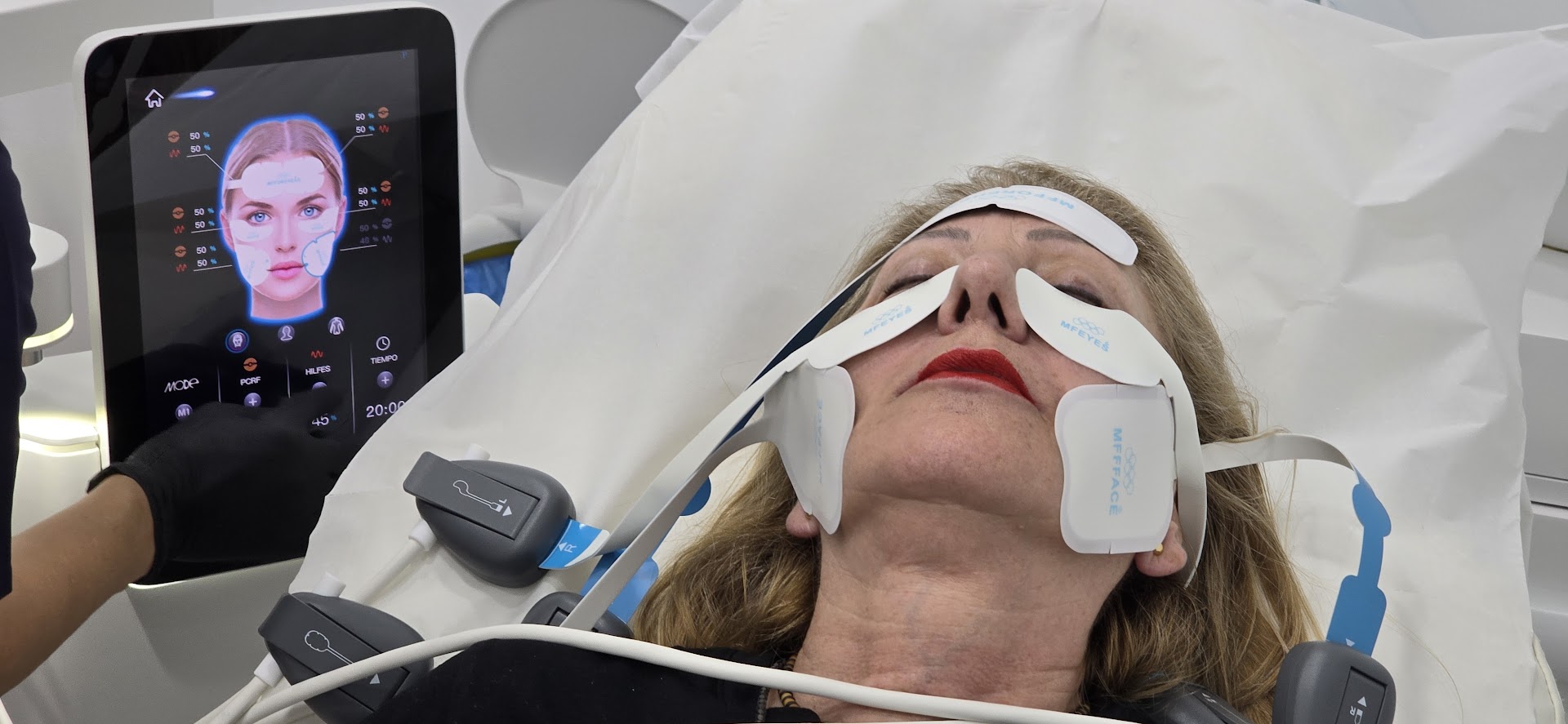 EMFACE Tratamiento para la flacidez facial Se trabaja en los pómulos, en la frente y en la papada Este tratamiento es una combinación de radiofrecuencia sincronizada y tecnología HIFES™ para combatir la flacidez facial y el descolgamiento muscular del rostro. EMFACE es un innovador tratamiento diseñado para abordar la flacidez facial y el descolgamiento muscular del rostro. Es único en su clase por ser el primer procedimiento que combina radiofrecuencia sincronizada (RF) y tecnología HIFES™, sin necesidad de agujas. Esta doble acción permite trabajar de manera simultánea tanto en la piel como en los músculos faciales, ofreciendo una solución efectiva y cómoda para rejuvenecer el rostro desde sus cimientos. El funcionamiento de EMFACE se centra en la mejora de la calidad muscular. A través de contracciones selectivas de los músculos y el aumento de la densidad y calidad de la estructura muscular, este tratamiento restaura el soporte natural de los tejidos faciales. Como resultado, el rostro recupera firmeza y elevación, devolviendo una apariencia rejuvenecida y redefinida, al tiempo que mejora la estructura subyacente de manera segura y no invasiva.