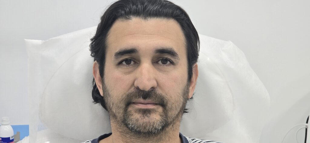 En su consulta, el Dr. Mendieta realiza tratamientos de neuromodulación con Botox que destacan por su efectividad y resultados naturales. Durante el procedimiento, el doctor aplica inyecciones precisas en áreas como la frente, el entrecejo y las patas de gallo, logrando reducir arrugas y líneas de expresión al relajar los músculos responsables de su formación.