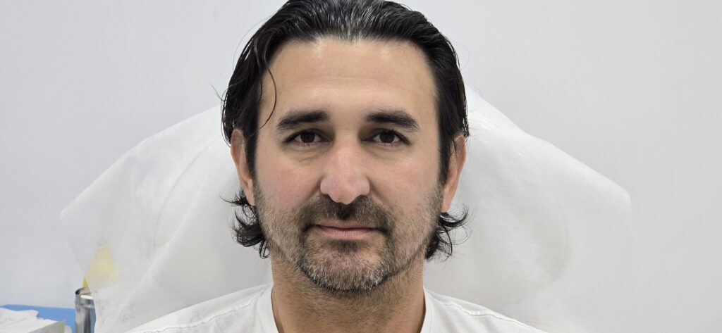 En su consulta, el Dr. Mendieta realiza tratamientos de neuromodulación con Botox que destacan por su efectividad y resultados naturales. Durante el procedimiento, el doctor aplica inyecciones precisas en áreas como la frente, el entrecejo y las patas de gallo, logrando reducir arrugas y líneas de expresión al relajar los músculos responsables de su formación.