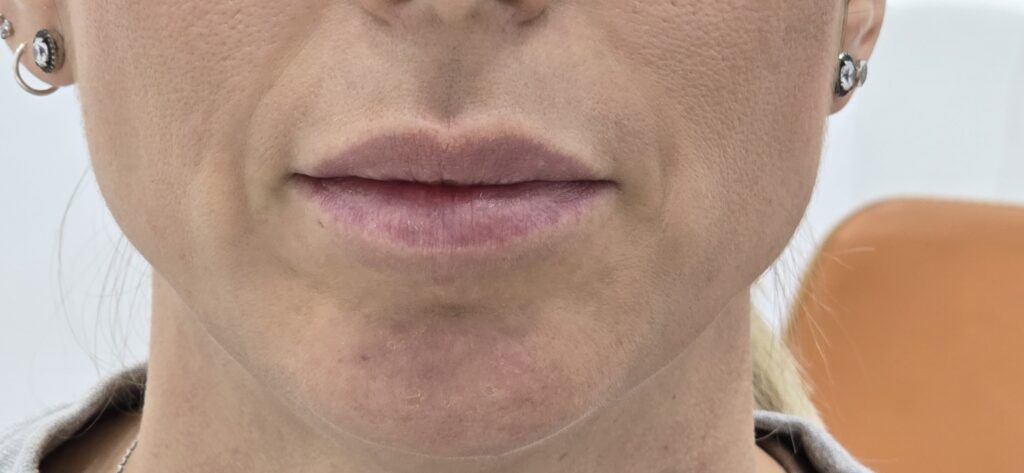 En Clínica Dr. Juan Mendieta, nos especializamos en tratamientos estéticos adaptados a las necesidades individuales de cada paciente. Un caso que refleja nuestra dedicación es el de una paciente que deseaba aumentar el volumen de sus labios de manera sutil y natural.